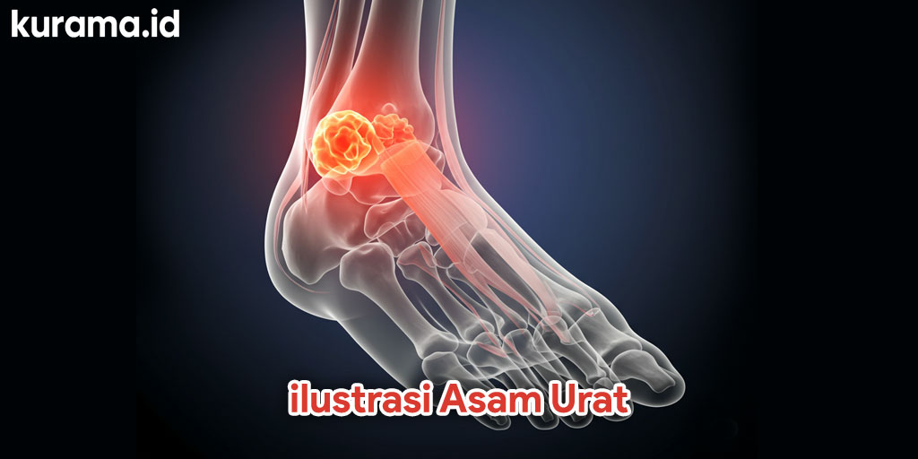 ilustrasi asam urat tinggi di bagian sendi kaki